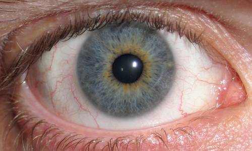 What Causes Blue Rings Around Brown Eyes