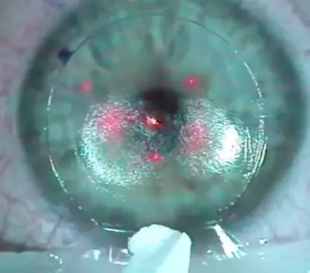 Pupil of the eye during laser Lasik surgery