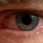 Allergic Conjunctivitis Causes, Symptoms and Treatment