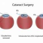 Cataract Surgery Recovery Time and Care Tips