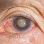 Cataracts types