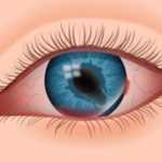 Eye and Eyeball Injuries Types and Remedies