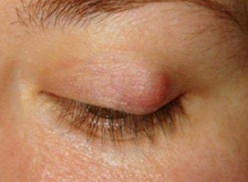 Eyelid Cyst Symptoms, Causes and Treatment