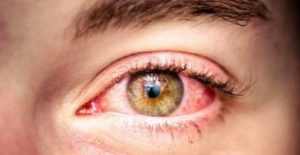 Eyes Itching: Causes and How to Treat It | EYExan.com