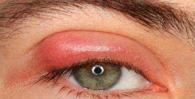 Swollen Eyelid Symptoms, Causes and Treatment