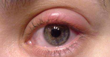 fluid retention in eyelid