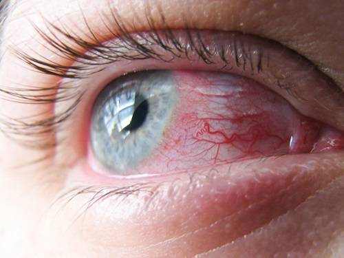 White Eye Discharge in Adults