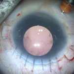 Cornea Transplant