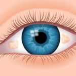 Bump on Eyeball (Pinguecula) Causes, Symptoms and Treatment