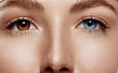 Different Colored Eye (Heterochromia) in Human