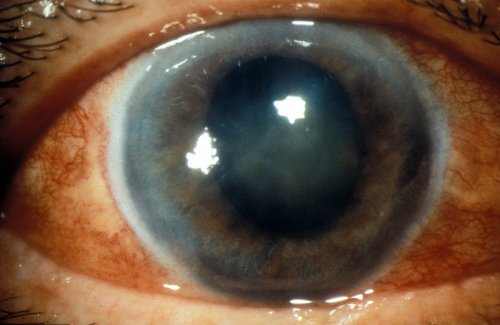 Glaucoma Treatment Options: Eye Drops, Medications