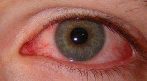 pink eye early symptoms