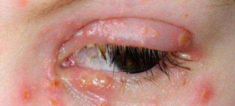 Ocular Herpes Causes, Symtoms and Treatment for Virus Eye Infection