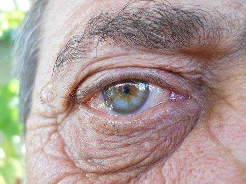 Eye Deterioration With Age