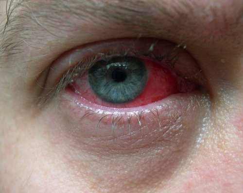 Photo of Pink Eye in men