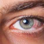 Causes of Dry Eyes in the Morning