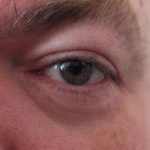 Causes of Puffiness Over Eyes