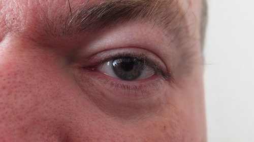 Causes of Puffiness Over Eyes