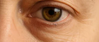 Medical visual illustrating the effects of ocular myasthenia gravis on eye function and appearance