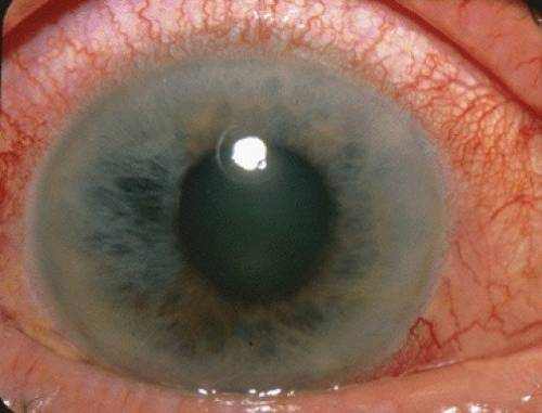 Causes of Narrow-Angle Glaucoma
