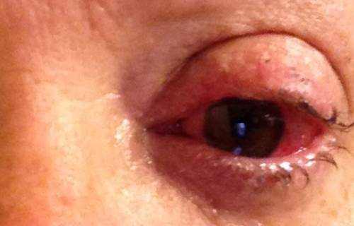 Sjogren's syndrome in eyes