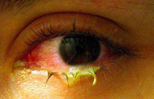 Mucus in eye