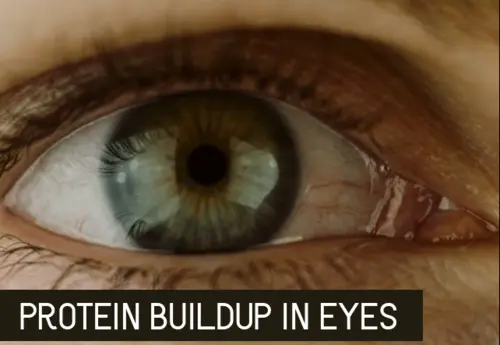protein buildup in eyes