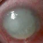 Acanthamoeba Keratitis or Why I Have Eye Pain After Contact Removal?