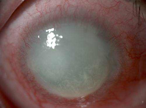Acanthamoeba Keratitis or Why I Have Eye Pain After Contact Removal?