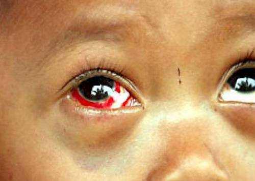 Bloodshot Eyes in Children