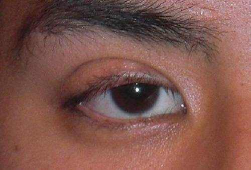 Drooping Eyelid (Ptosis)