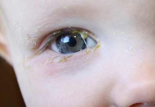 Goopy Eyes in Children