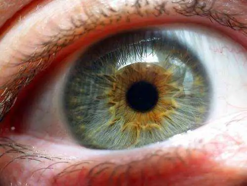 Is LASIK Eye Surgery Permanent?
