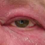 Ocular Rosacea