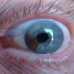 Ocular melanoma
