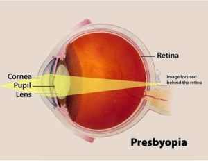 Presbyopia: Symptoms, Causes and Treatment | EYExan.com