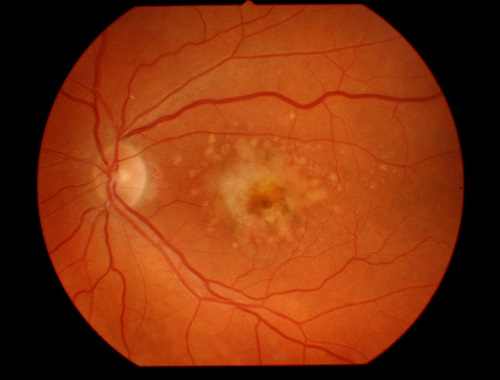 Vitamins and Other Types of Prevention for Macular Degeneration