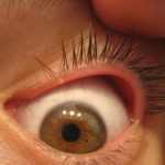 White Bump Inside Eyelid