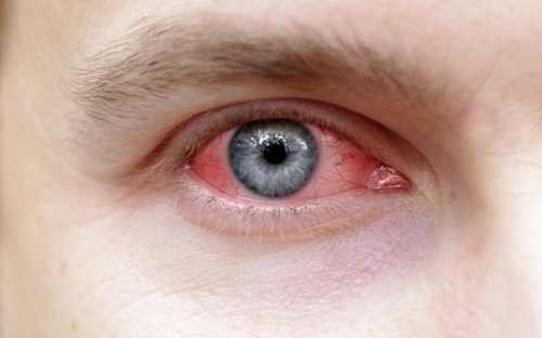 Difference Between Pink Eye and Allergies