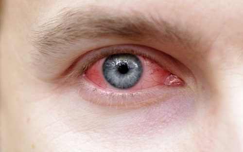 difference-between-pink-eye-and-allergies-eyexan