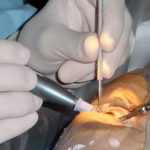 Glaucoma Surgery