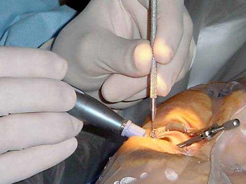 lasik eye surgery doctors