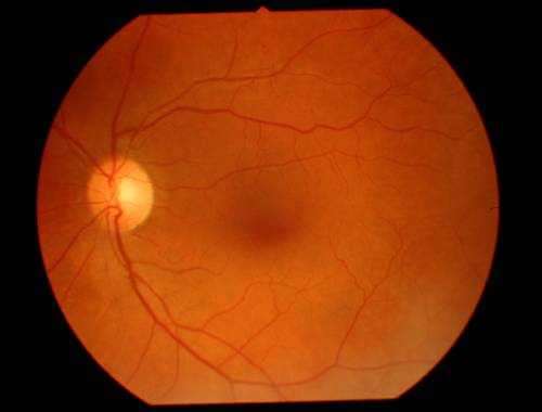 background retinopathy