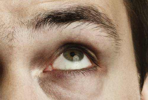 tired-eyes-causes-symptoms-and-treatment-eyexan