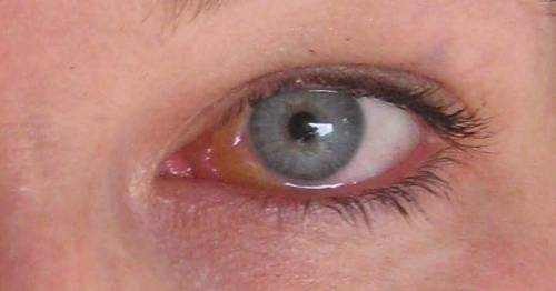 Swollen Tear Duct Causes Symptoms And Treatment 