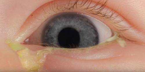 Green Mucus in Eye in Toddler