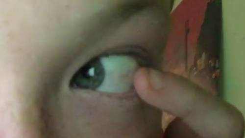 sensation of eyeball hurts to touch