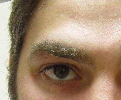 what-causes-swelling-above-the-eyebrow-eyebrowshaper