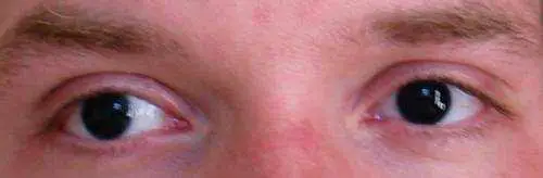 Eye Without Iris Causes Symptoms And Treating Aniridia