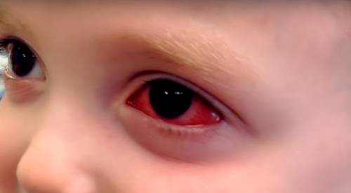 symptoms of pink eye in toddlers